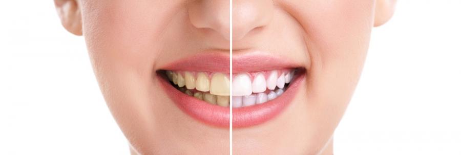 teeth whitening services